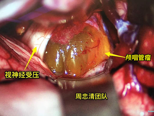 男子患脑肿瘤近乎失明 医生妙手让他重见光明