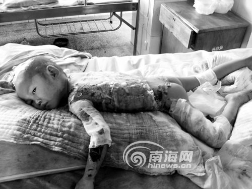 海南定安县3岁女童被一锅沸水烫伤 生命垂危(